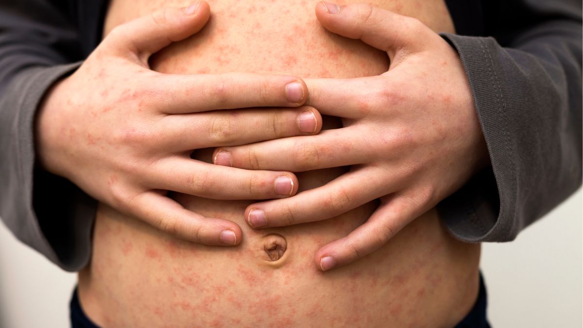 Cara Mencegah Campak