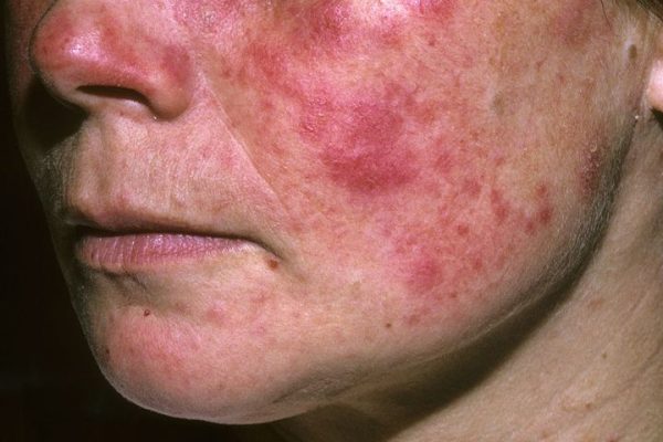 Penyakit Lupus: Kenali Gejala, Tantangan, dan Cara Merawatnya Penyakit Lupus
