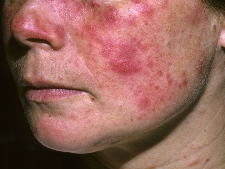 Penyakit Lupus