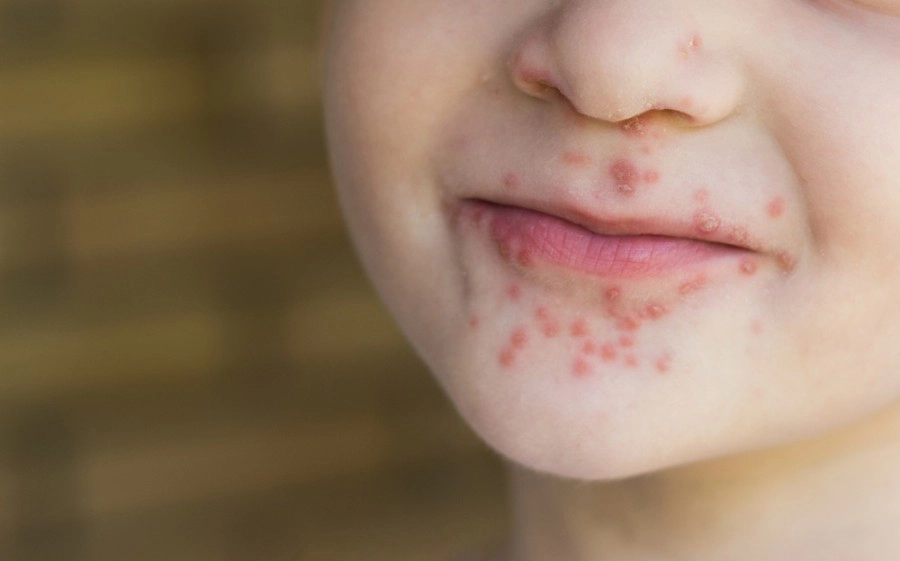 Cara Mencegah Campak