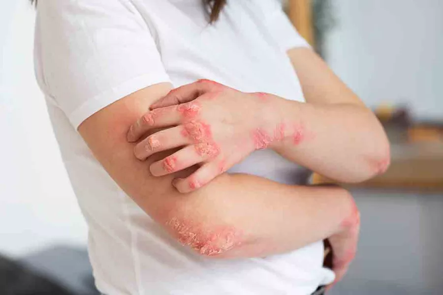 Gejala Alergi Makanan