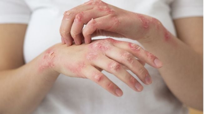 Gejala Alergi Makanan