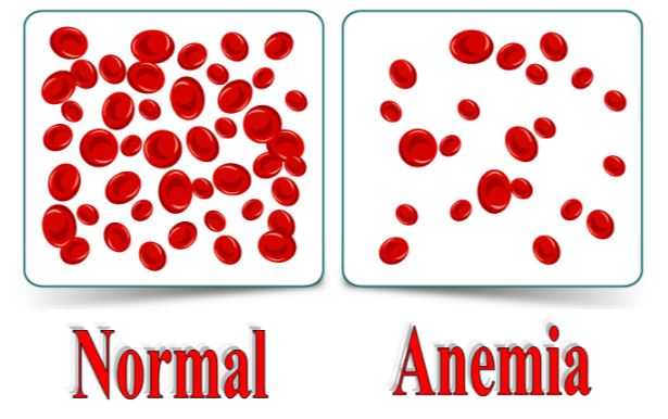 Anemia
